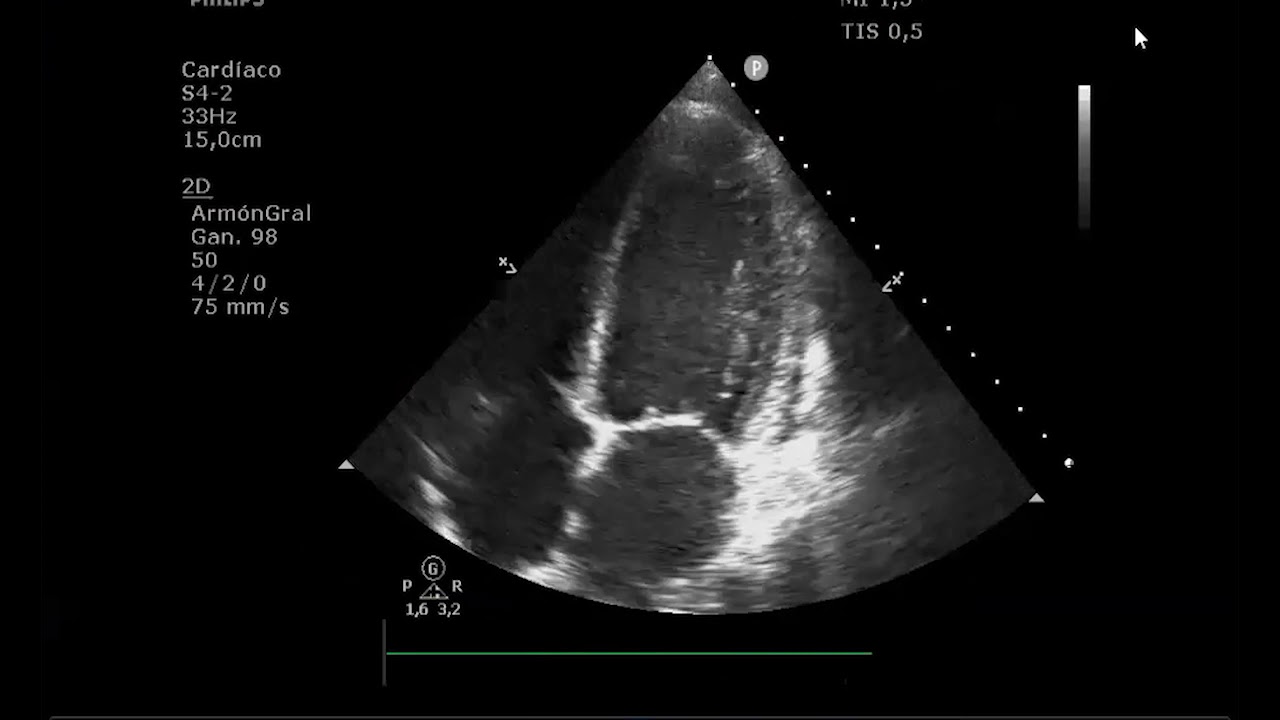 Ateneo IMedCV - Miocardiopatía puerperal - Dr. Santiago Decotto