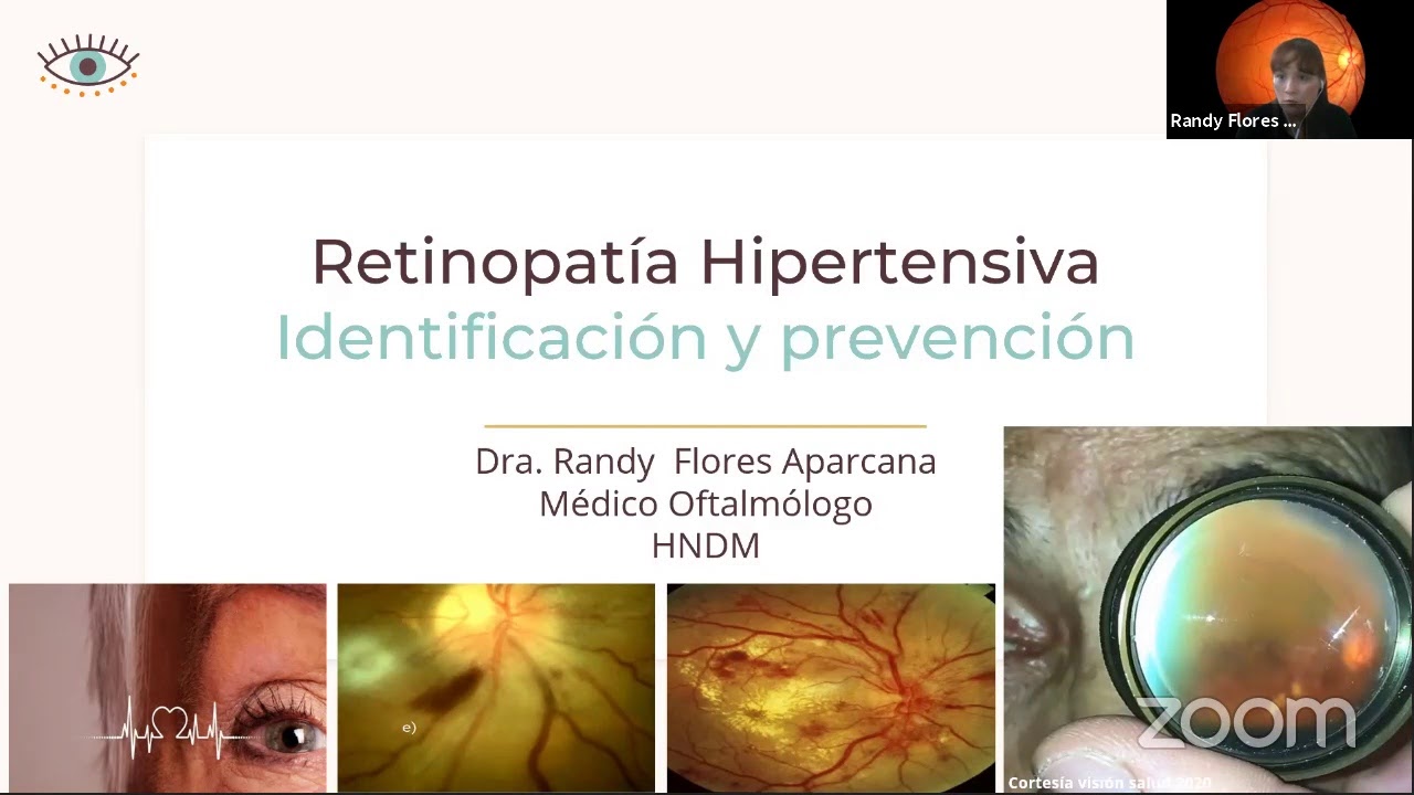 RETINOPATÍA HIPERTENSIVA