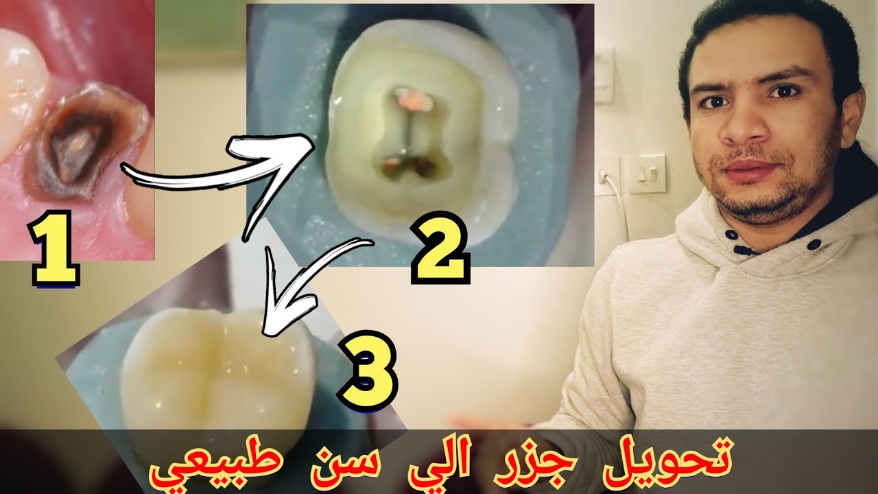 شرح بناء ضرس متهدم و تحويله الي ضرس طبيعي | تركيب دعامه الاسنان