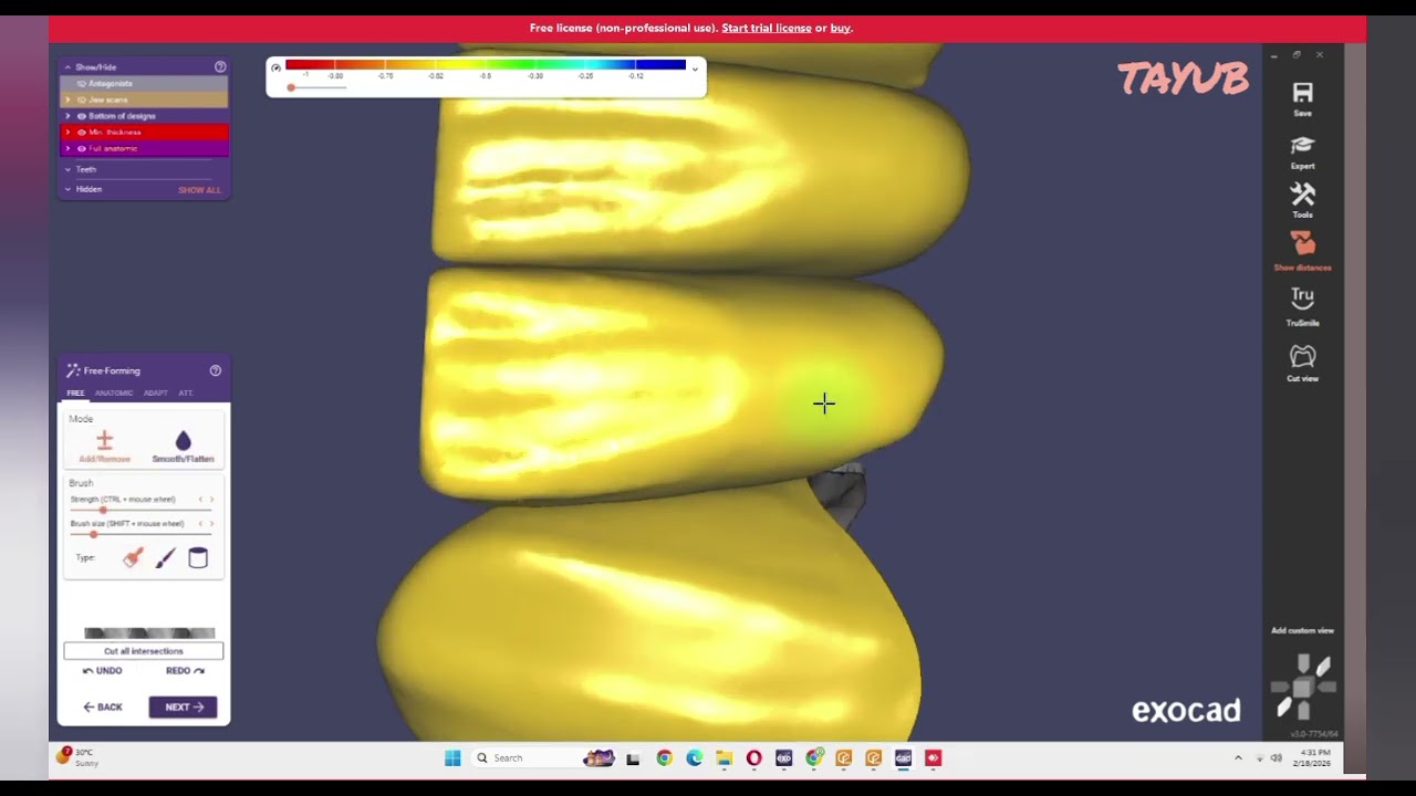 Dental CAD CAM | Exocad | 3D Printing | UP3D Milling | Dental Lab Tips