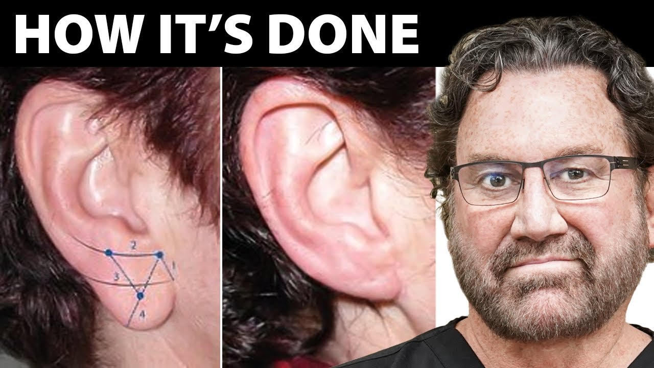 What technique is used for earlobe repair surgery? Plastic Surgeon Answers