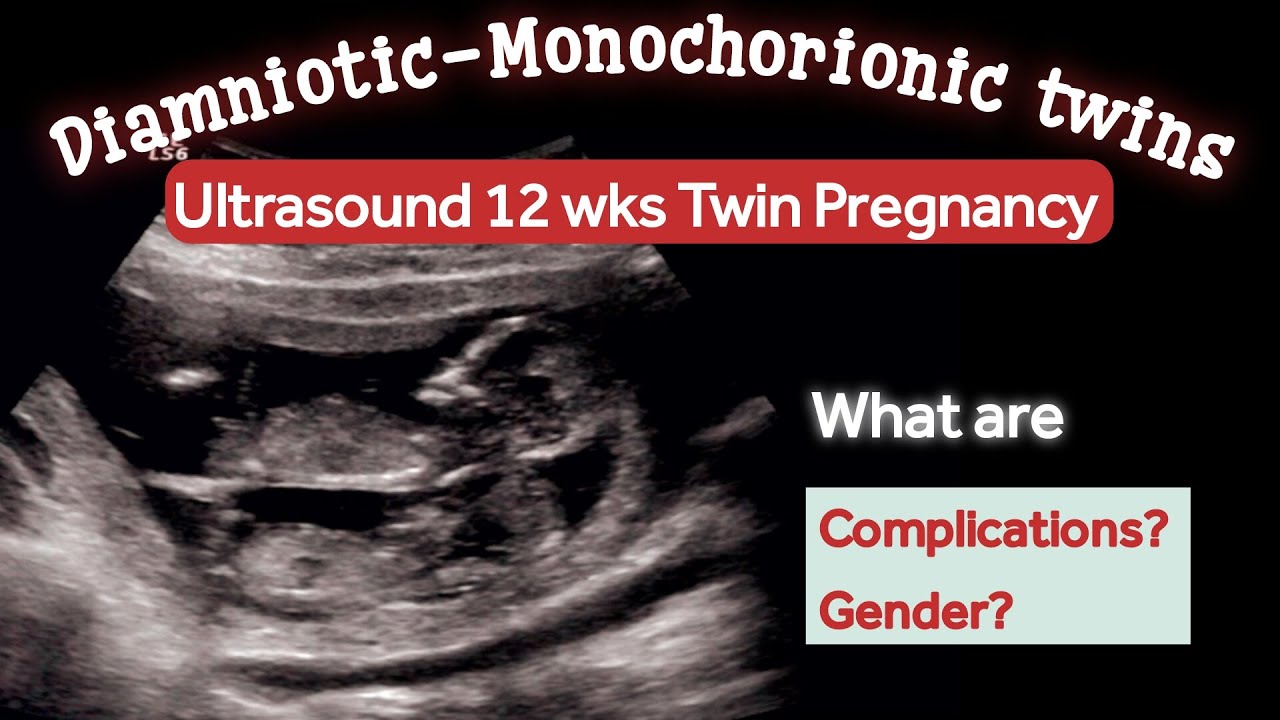 12 Weeks Twin Pregnancy Ultrasound | Monochorionic diamniotic | what can be Complications