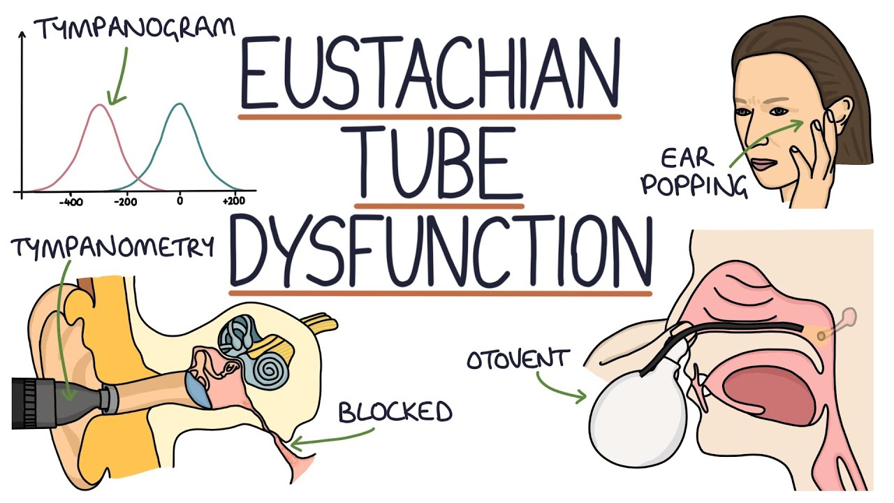 Understanding Eustachian Tube Dysfunction