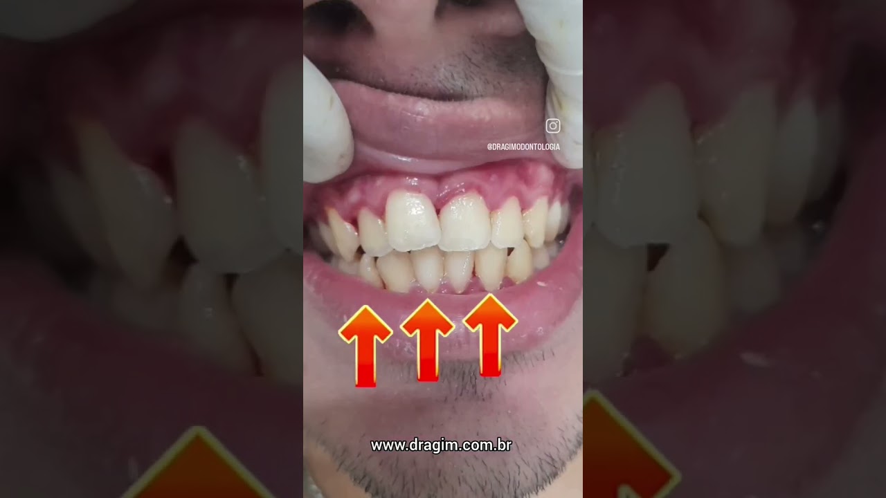 Sinais de gengivite e periodontite #dentista #odontologia #gengiva #periodontite #periodontist