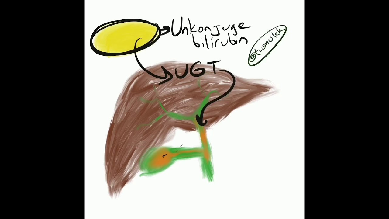 Hiperbilirubinemiler - Dahiliye
