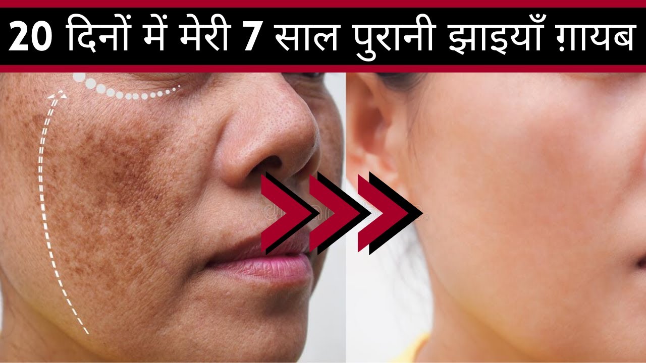 My 7 Year Old Pigmentation gone in 20 days. 20 दिनों में मेरी 7 साल पुरानी झाइयाँ ग़ायब I