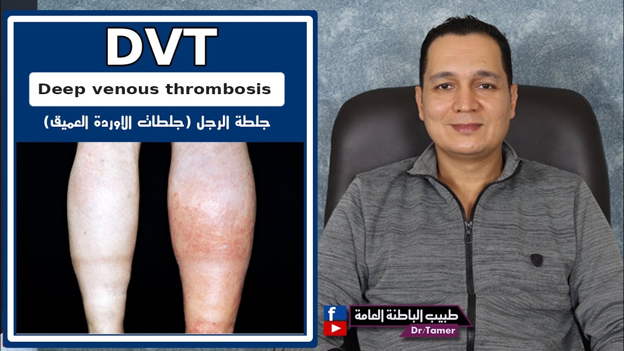 DVT deep venous thrombosis / جلطات الاوردة العميقة - جلطة الرجل