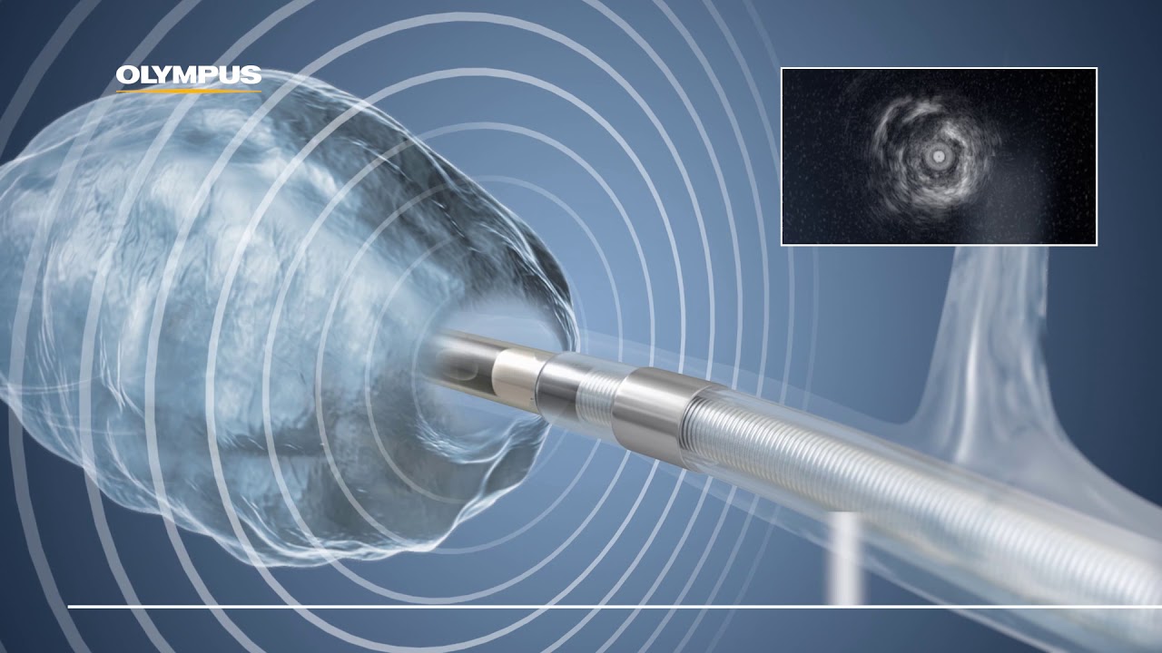 Peripheral Bronchoscopy with Radial EBUS