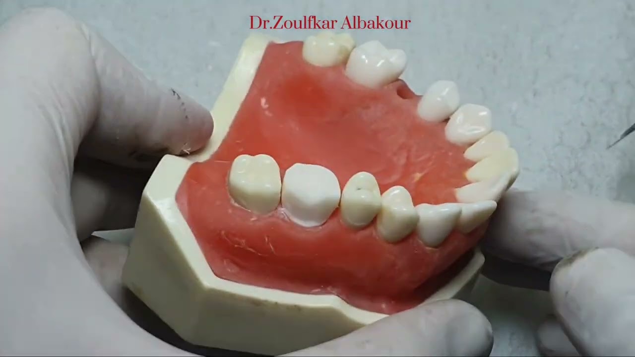 Prepartion the upper first molar PFM
