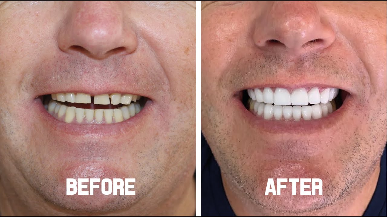 Hollywood Smile (Zirconium Crowns) - Andrew From Manchester.