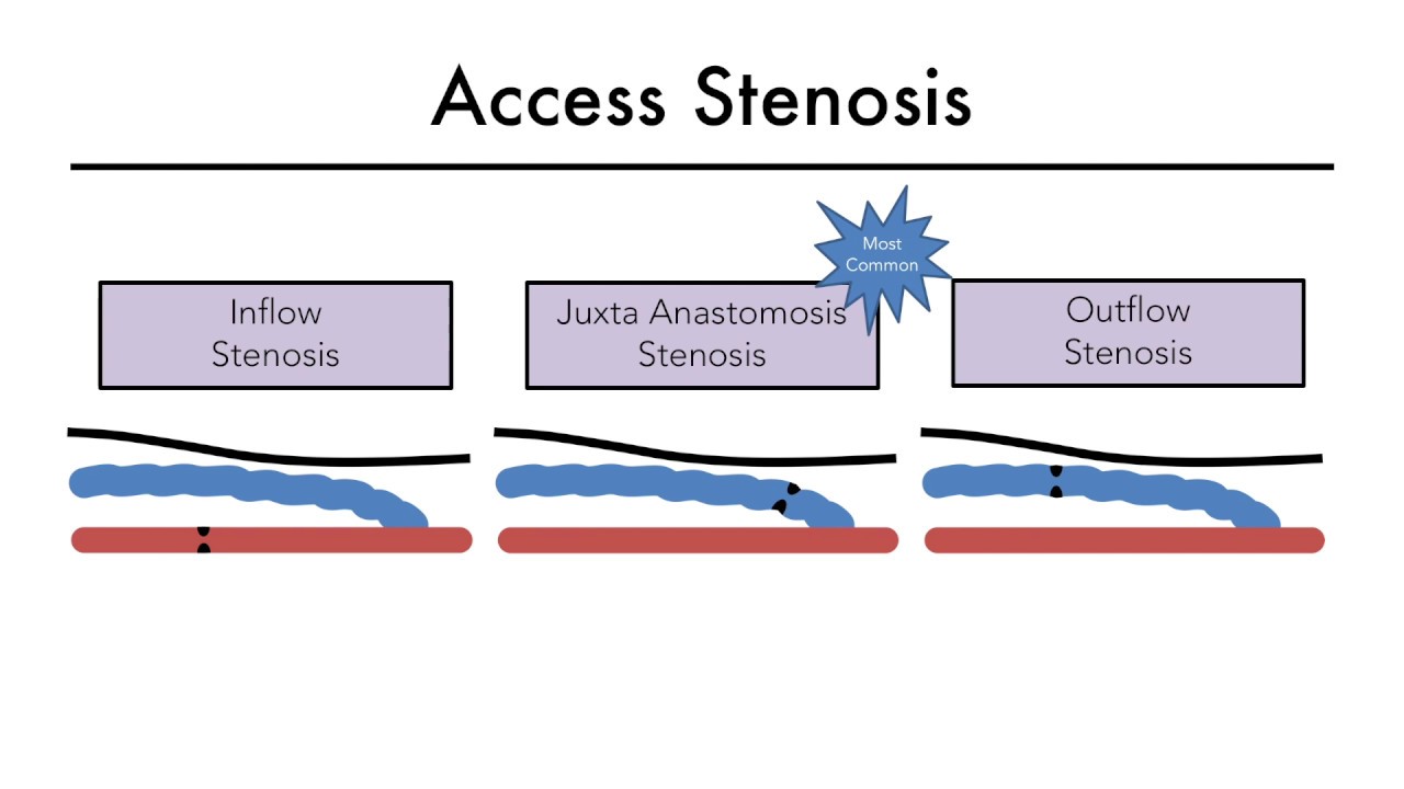 Hemodialysis Access 101 04 - Part 1: Access Stenosis