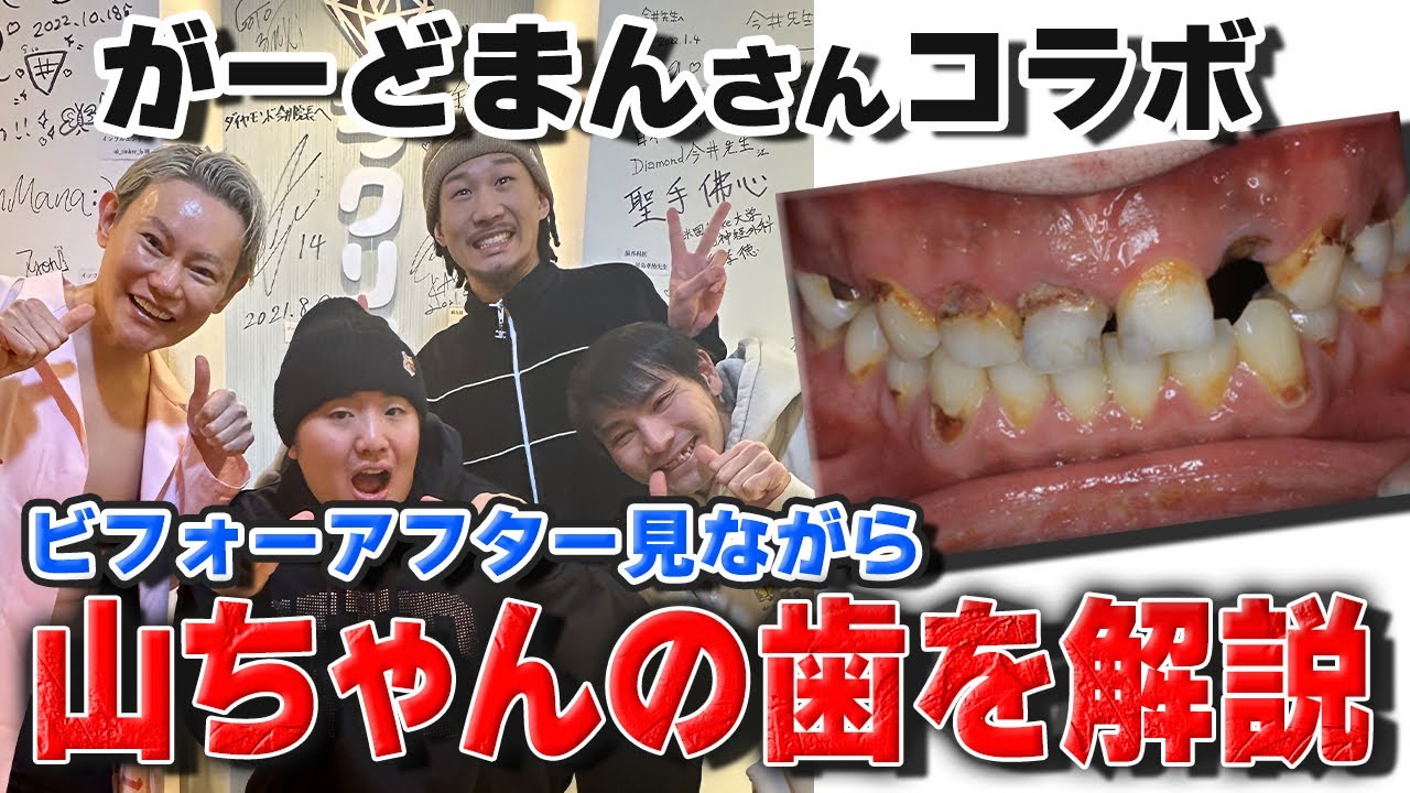 【がーどまんコラボ】山ちゃんのボロボロの歯を治してみた！解説