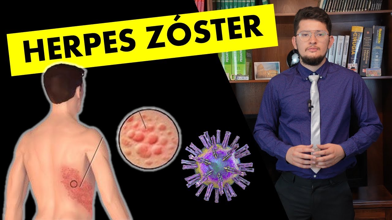 💥 HERPES ZÓSTER (Culebrilla) | Causas, Síntomas y Tratamiento