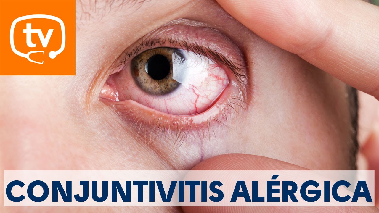 Claves sobre la conjuntivitis al&eacute;rgica