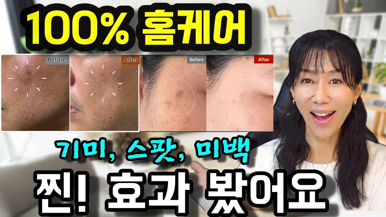 병원 스탑!!!! 병원가기 전에 집에서 이 방법부터 꼭 써보세요. 50대부터 80대까지 100% 효과 본 기미 홈케어!