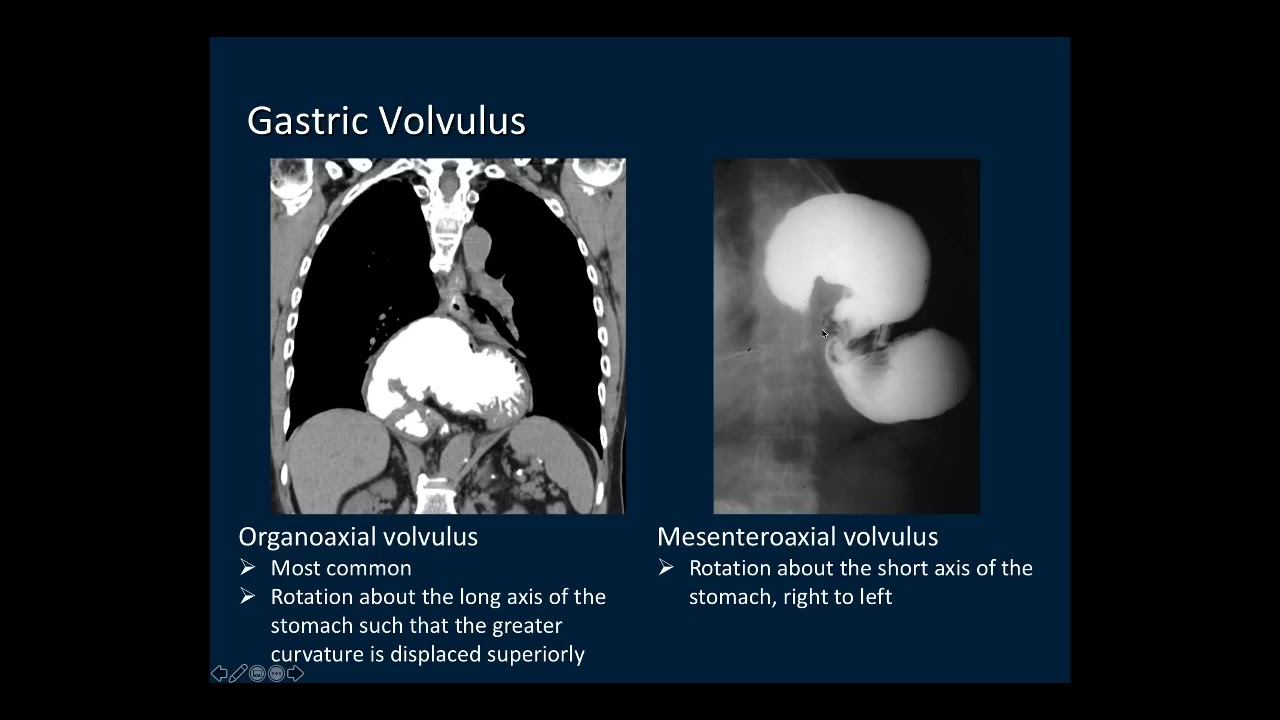 Imaging disease of stomach