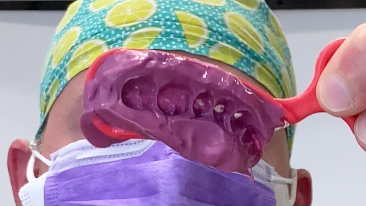 The Triple Tray Impression