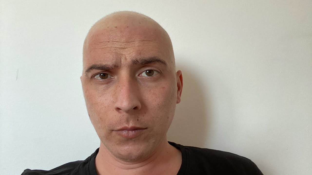 Chimioterapia 2/4 Mi a căzut parul!