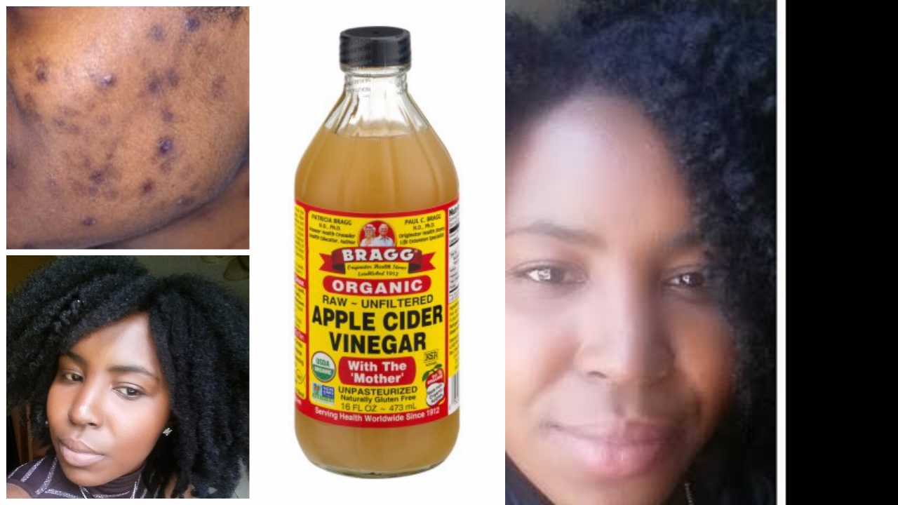 HOW I CLEARED MY ACNE WITH APPLE CIDER VINEGAR  Toner! DIY