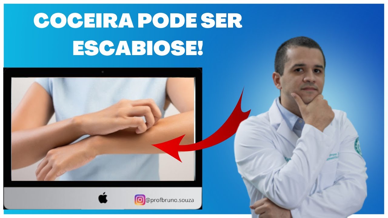 Escabiose (sarna humana) - Sintomas e tratamento