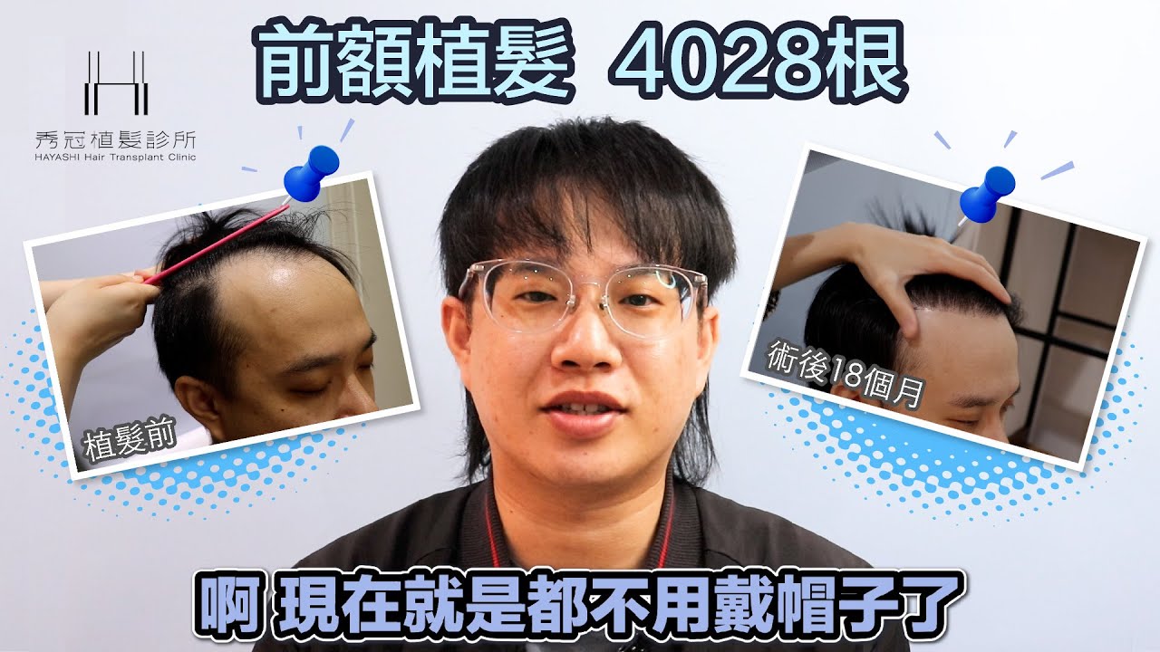 植髮後每個階段會如何? 本案例都有清晰撥髮照片+解說，還有植髮後1年半心得訪問!前額植髮+髮際線重建 FUE 4028根