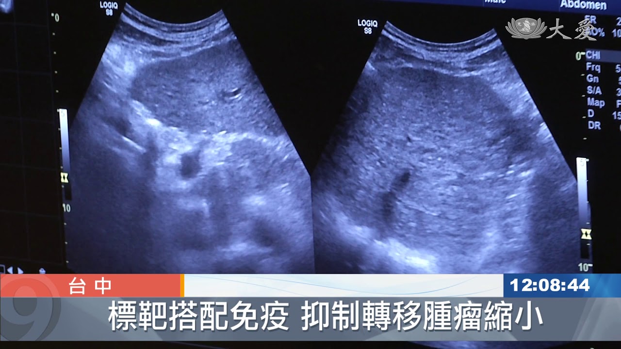 巨大肝腫瘤已擴散 多管齊下除病灶
