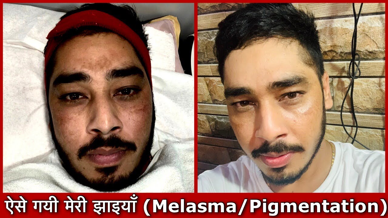 My Melasma/Pigmentation gone in just 2 months. आपकी Diet से 2 महीनों मे ही झाइयाँ ग़ायब हो गयी।