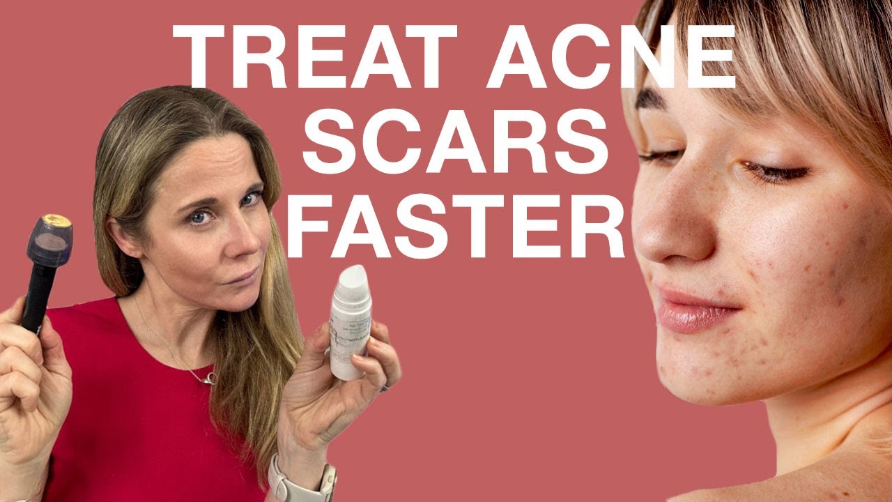 How to fade acne scars faster: Dermatologist guide