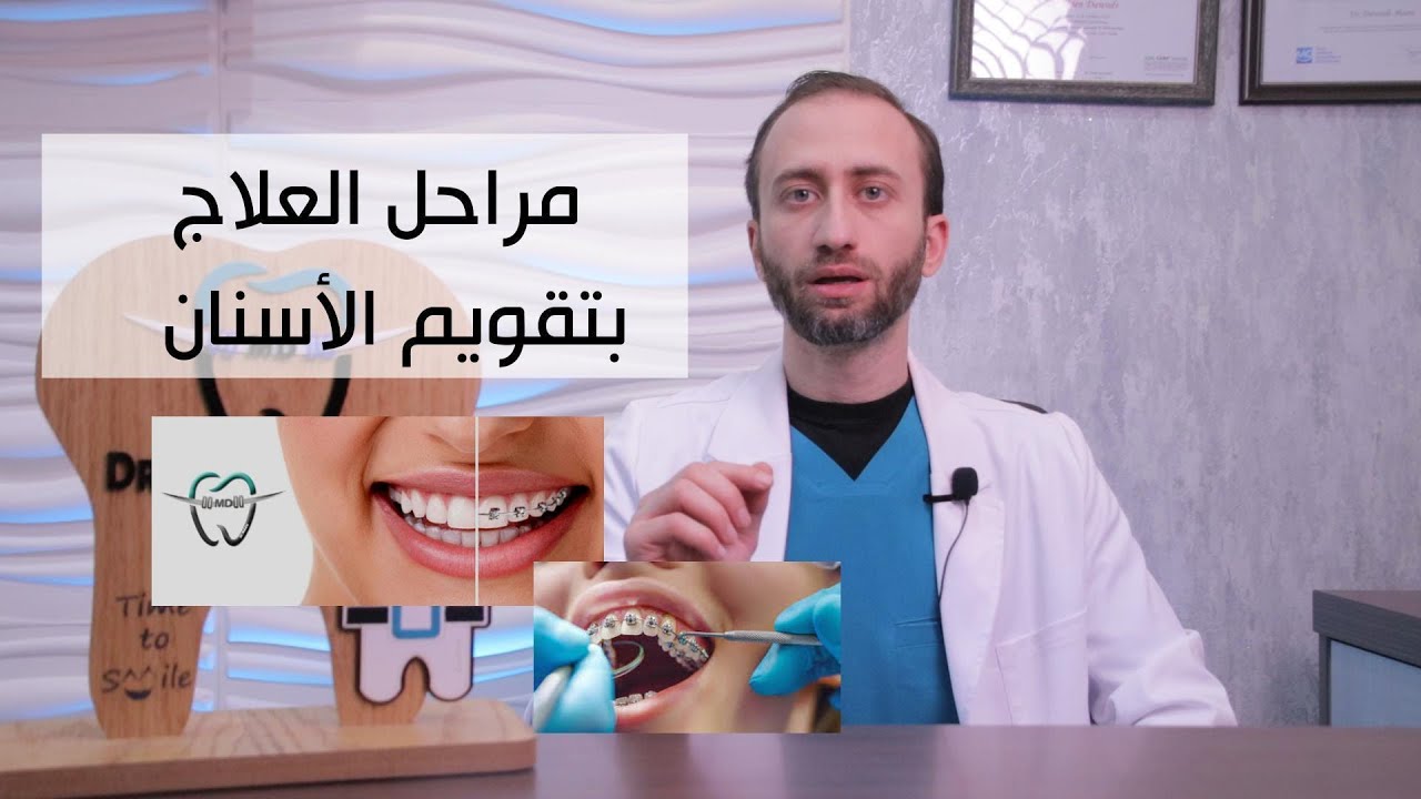 مراحل العلاج بتقويم الأسنان من تركيب تقويم الاسنان إلى انتهاء العلاج والمثبت