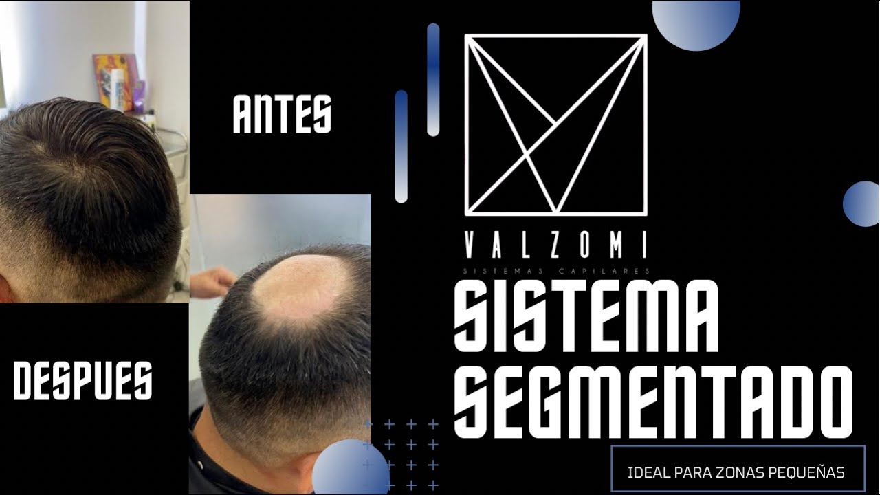 Prótesis capilar para coronilla
