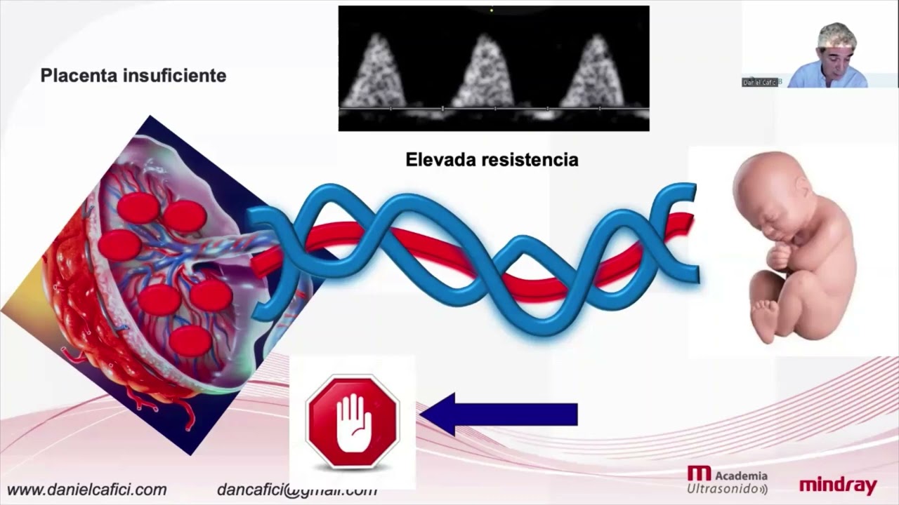 [M-Academy Ultrasound] Uso adecuado del Doppler durante la Gestación
