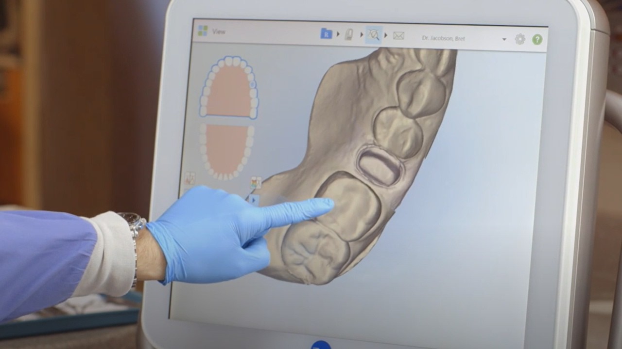 How to create digital impressions for a single unit crown with iTero Element™ dental scanner