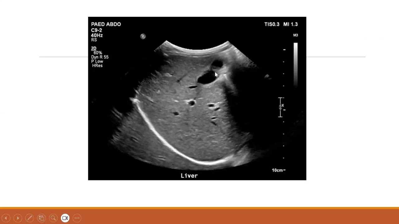 Pediatric abdominal ultrasound: Liver and biliary system. 