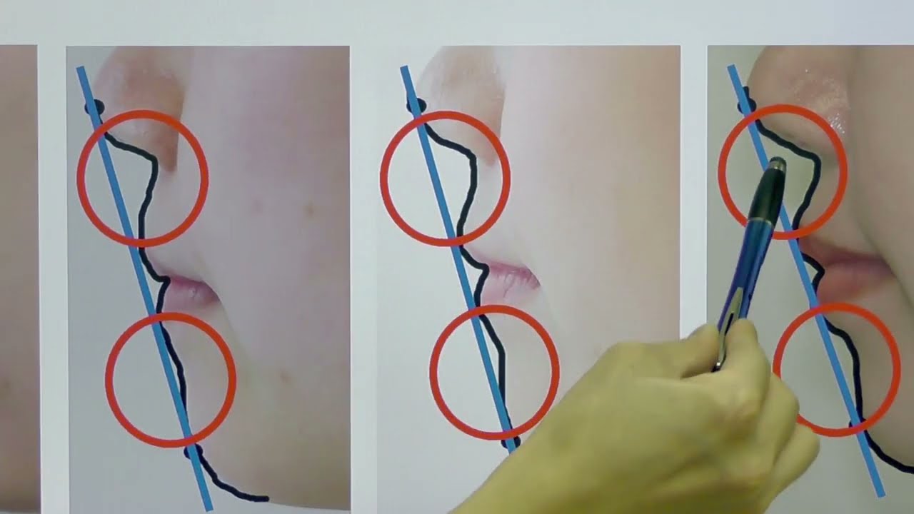 【セットバック整形手術】術後の「腫れ・むくみ」等ダウンタイムはどの程度？ ～ 大阪矯正歯科グループ辻和志