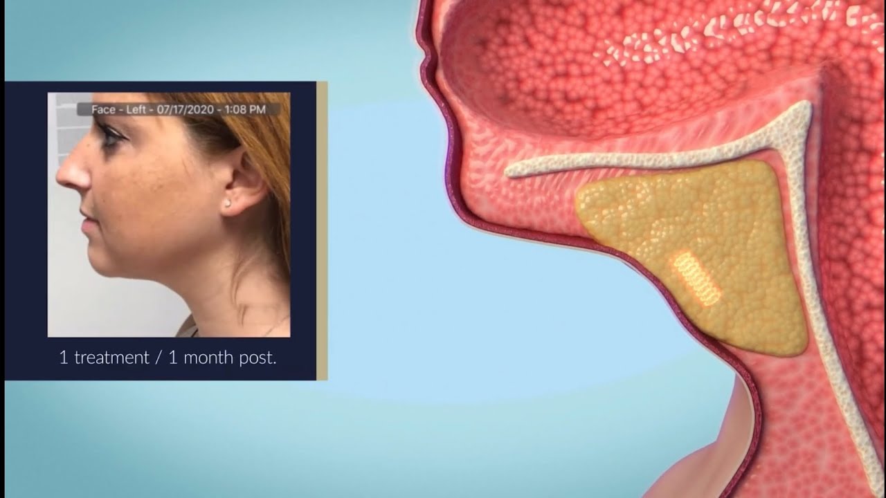 Youthful Looking Face In Just One Treatment? Watch How Agnes RF Does It! at Spa Black