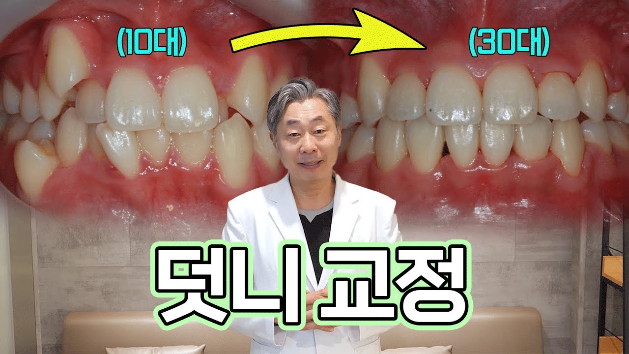 13년 전 전체 교정한 환자 지금은 어떨까? 교정 전체 흐름부터 후관리 하는 법까지