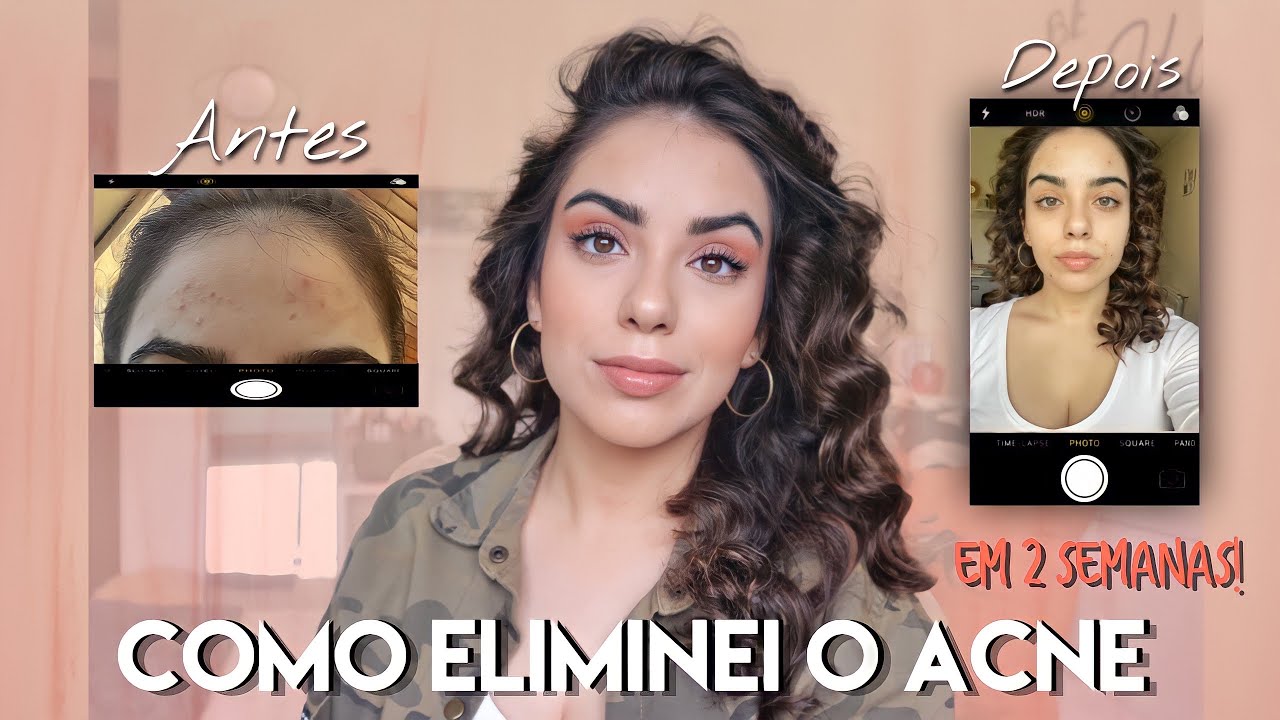 COMO ELIMINAR ACNE RÁPIDO! | COMO TRATEI O ACNE EM 2 SEMANAS