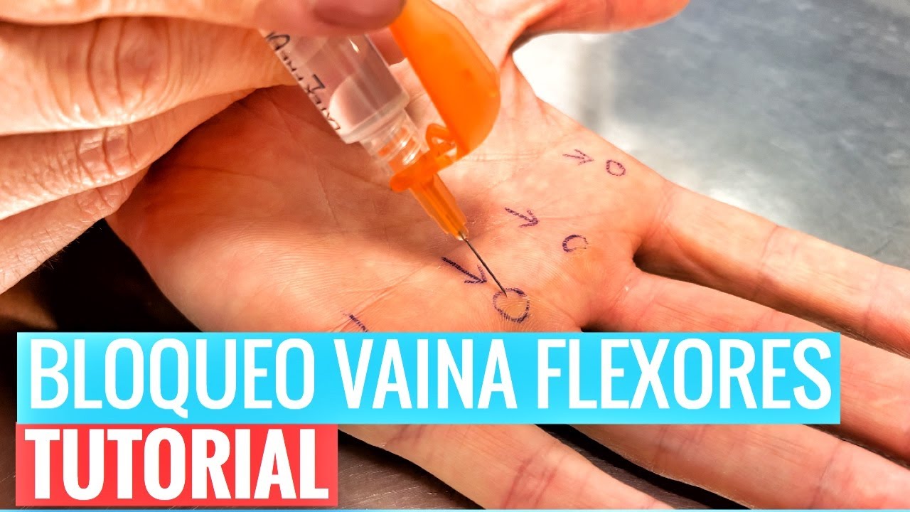 BLOQUEO VAINA TENDÓN FLEXOR