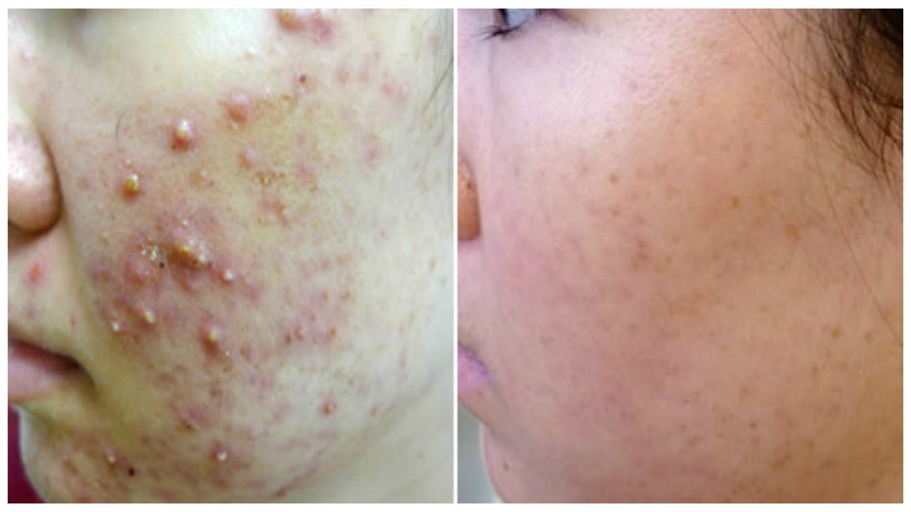 Overnight Removal Of Acne & Acne Scars I Best Indian Home Remedies | Facial Mask