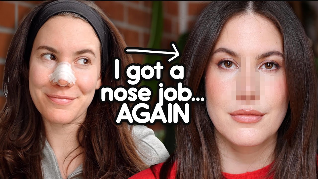 I Got (Another) Nose Job 👀 | My Revision Rhinoplasty Journey & Recovery Vlog