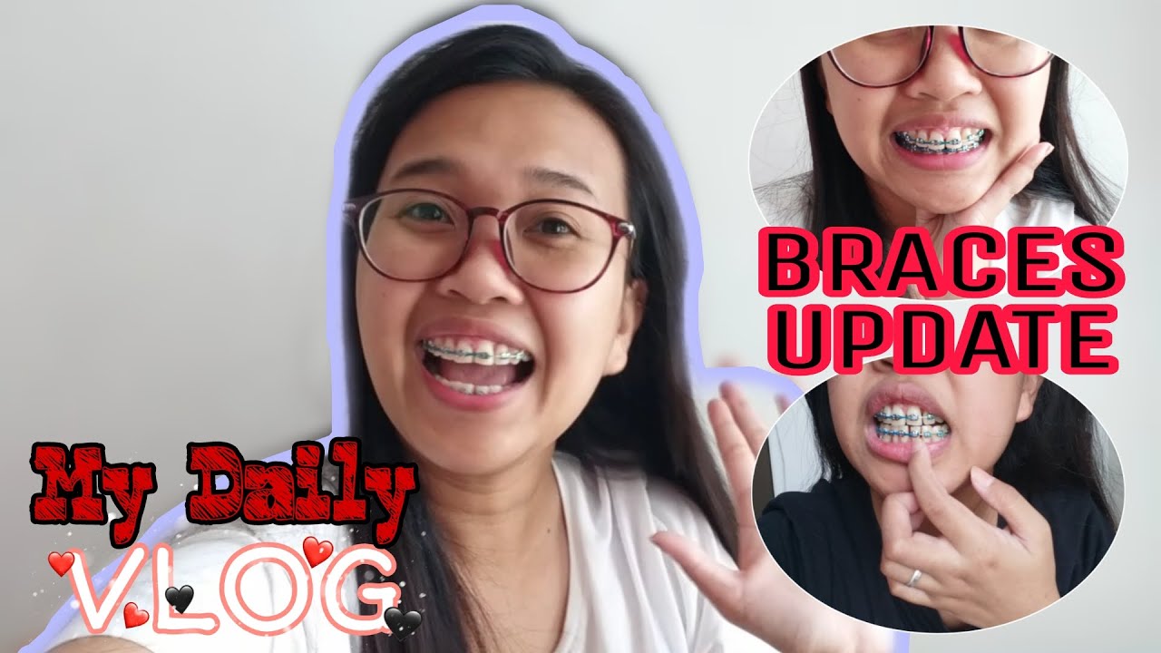 BRACES UPDATE AND DAILY VLOG(LIFE IN MALAYSIA 🇲🇾)|EM-KEI CHANNEL