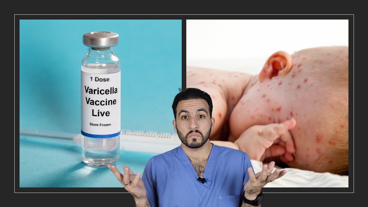 العنقز  (الجدري المائي) أعراضه و علاجه وطرق الوقاية منه