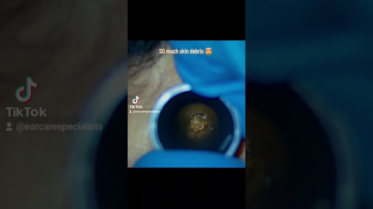 Unbelievable amount of compacted skin removed from this patient's ear 😱 #ear #skin #earcleaning