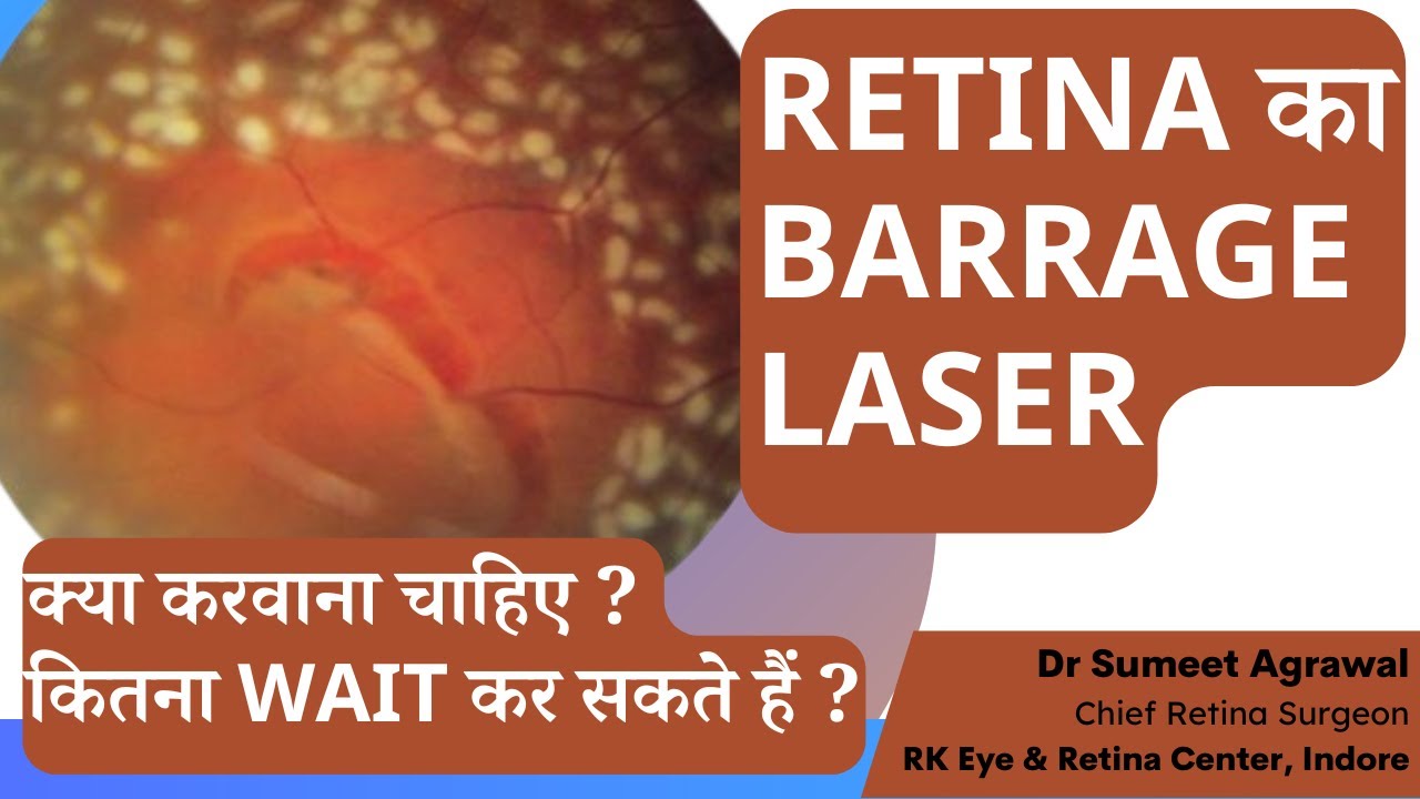 RETINA में कमज़ोरी का इलाज BARRAGE LASER !! क्या करवाना चाहिए ??