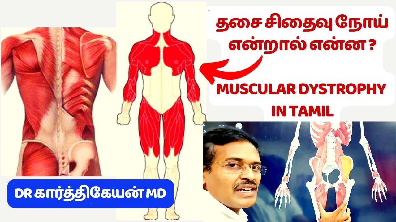 தசை சிதைவு நோய் என்றால் என்ன ? | muscular dystrophy in tamil