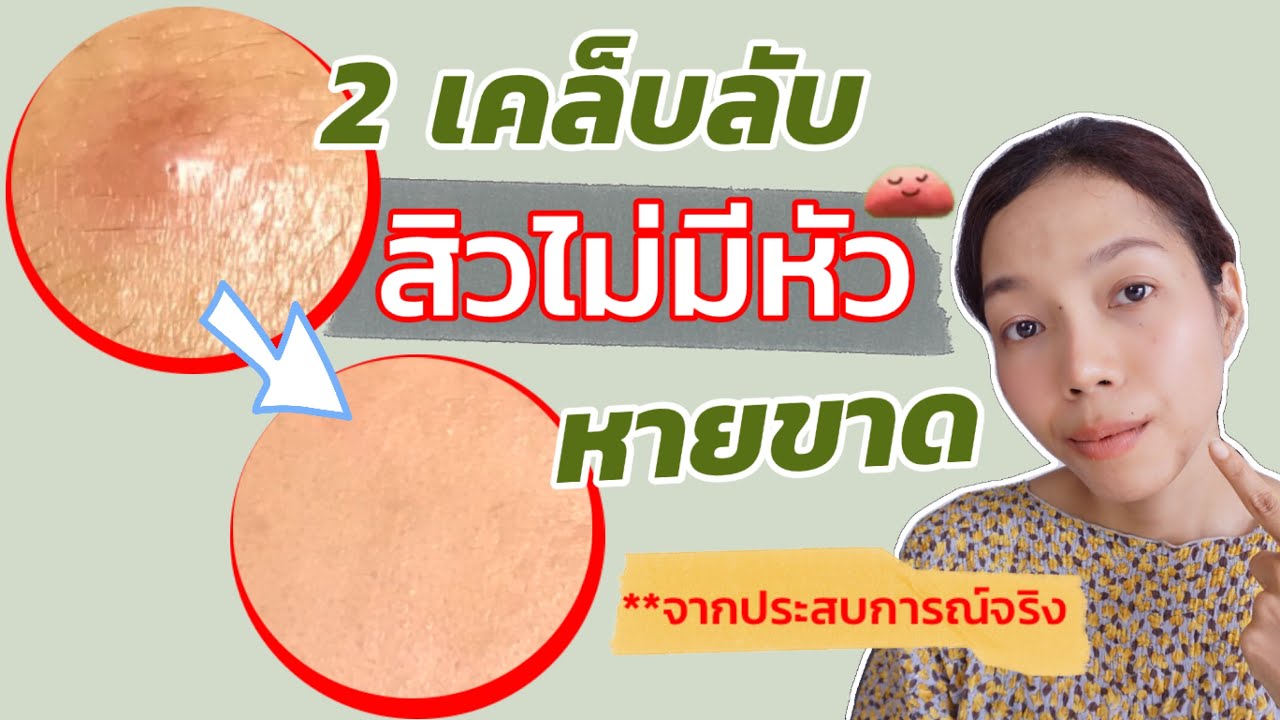 สิวไม่มีหัว ทำไงให้หาย จากประสบการณ์จริง!! ไม่ต้องบีบ แคะแกะเกาให้เป็นรอย | รักษาสิว | เฮลตี้นี่คะ