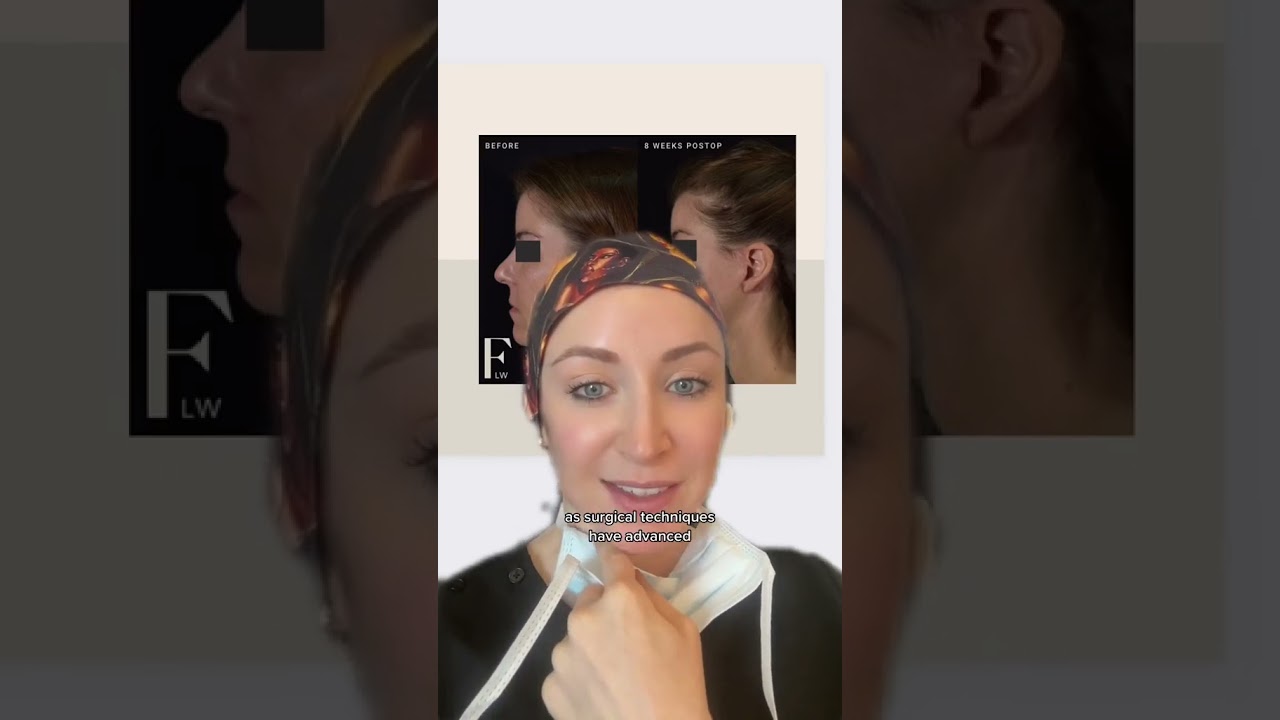 Reducing the submandibular gland for better neck results