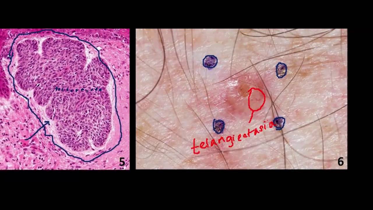 Introduction to NMSC Skin Cancer #2: Basal Cell Cancer (BCC) and Squamous Cell Cancer (SCC)