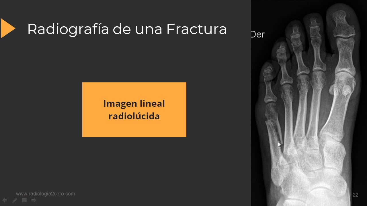 Radiología de las fracturas paso a paso
