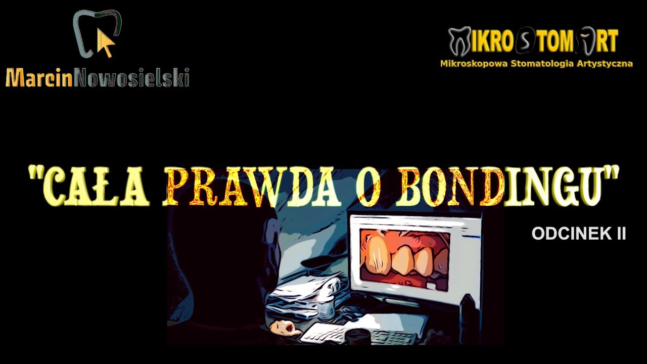 Bonding, licówki - cała prawda na temat bondingu. Wady, zalety, wskazania - część 2